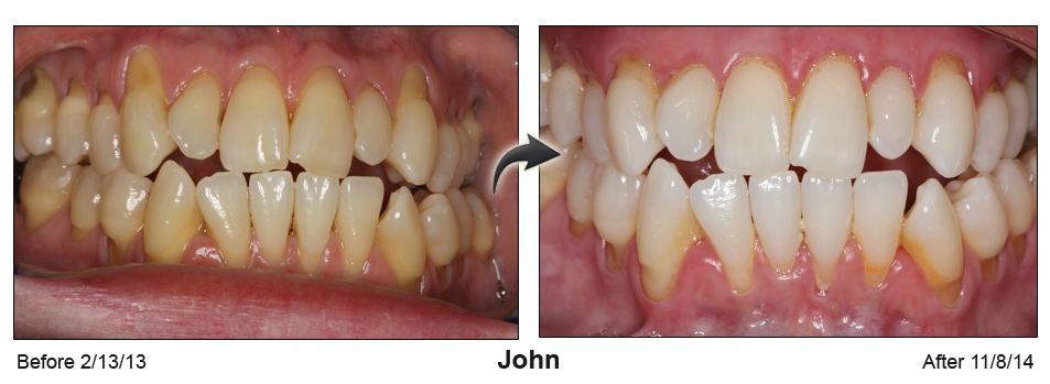 Before and Afte picture